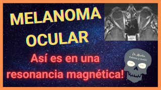 melanoma ocular en resonancia magnetica